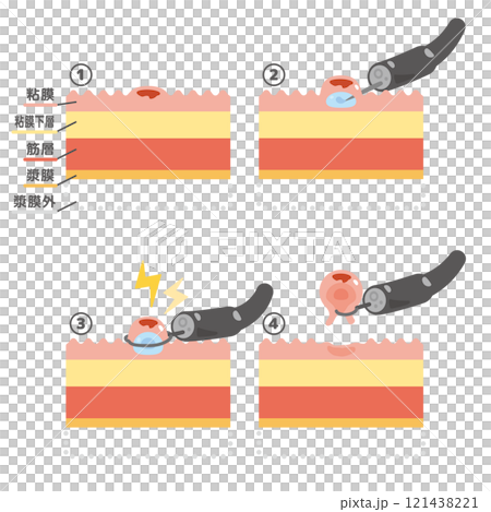 内視鏡治療　EMRのイラスト 121438221