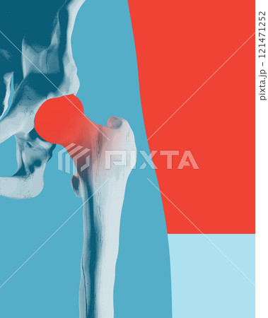 Poster. Contemporary art collage. 3D model of human hip bone with red bright inflammation in joint on bright background with negative space. Poster. Contemporary art collage. 3D model of human hip bone with red bright inflammation in joint on bright background with negative space. 121471252