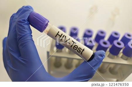 Sample blood for screening test for HIV test 121476350