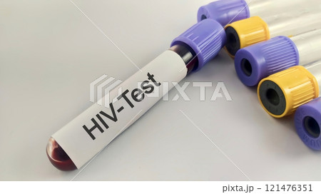 Sample blood collection tube with HIV test label on HIV infection screening test form. 121476351