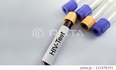 Sample blood for screening test for HIV test Sample blood for screening test for HIV test 121476355
