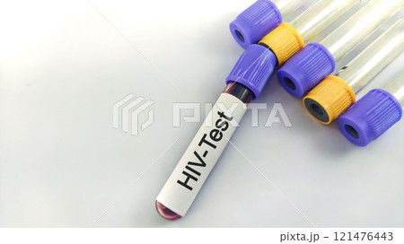 Sample blood collection tube with HIV test label on HIV infection screening test form. Sample blood collection tube with HIV test label on HIV infection screening test form. 121476443