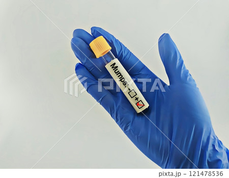 Blood sample positive with mumps virus 121478536