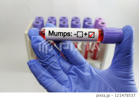 Blood sample positive with mumps virus 121478537