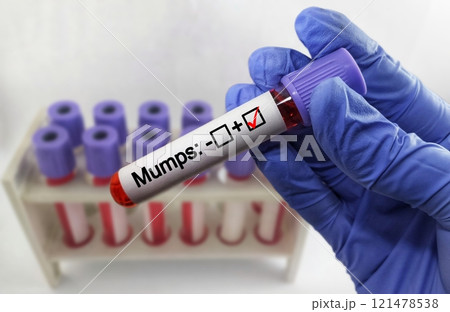 Blood sample positive with mumps virus Blood sample positive with mumps virus 121478538