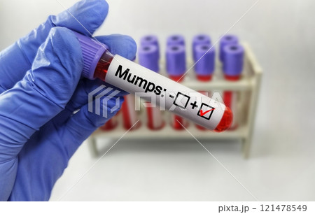 Mumps Test tube with blood sample in infection lab 121478549
