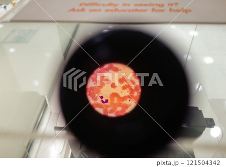 view through the microscope lens of platelet with virus colony. close up 121504342