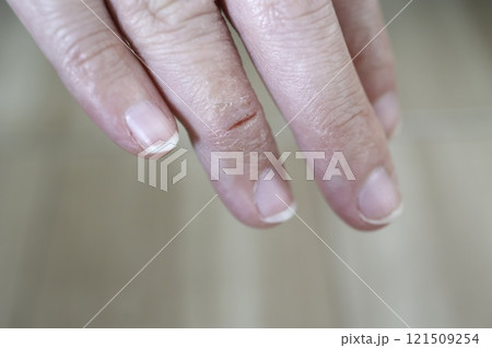 あかぎれが発生した女性の指 あかぎれが発生した女性の指 121509254