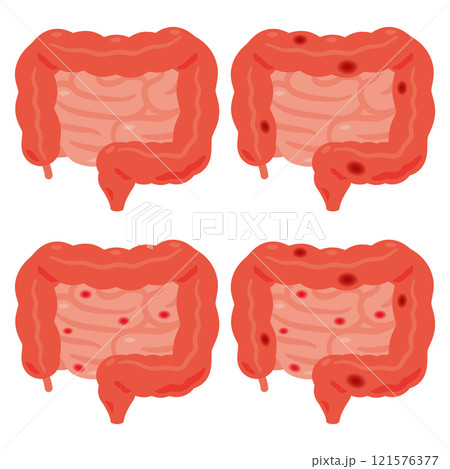 炎症が起きた大腸と小腸のイラスト 炎症が起きた大腸と小腸のイラスト 121576377