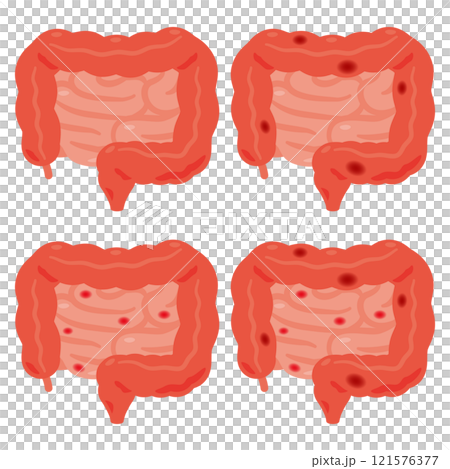 炎症が起きた大腸と小腸のイラスト 炎症が起きた大腸と小腸のイラスト 121576377