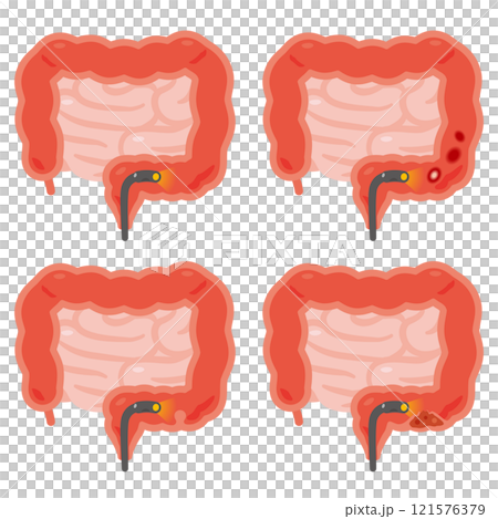 Illustration set of intestines in various states undergoing colonoscopy examination 121576379