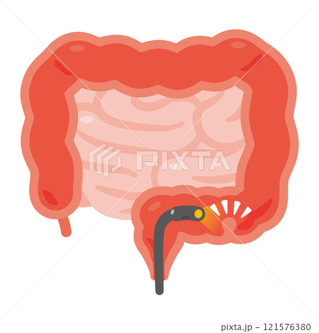 大腸カメラ検査を受けてポリープが見つかった腸のイラスト 大腸カメラ検査を受けてポリープが見つかった腸のイラスト 121576380