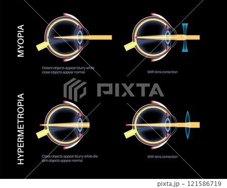 Farsightedness and nearsightedness correction Farsightedness and nearsightedness correction 121586719