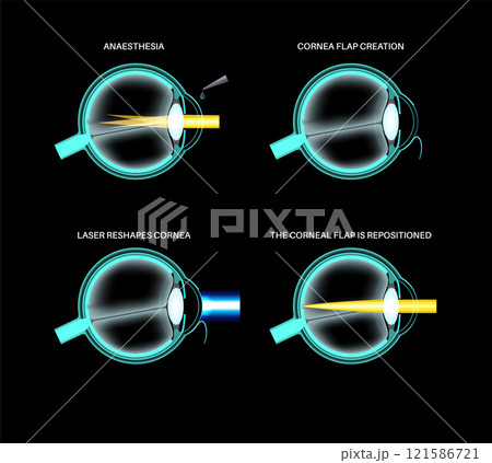 LASIK eye surgery 121586721