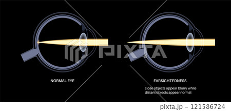Farsightedness eye disease Farsightedness eye disease 121586724