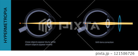 Farsightedness lens correction 121586726