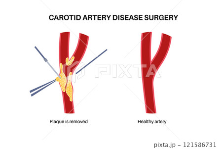 Carotid artery surgery 121586731