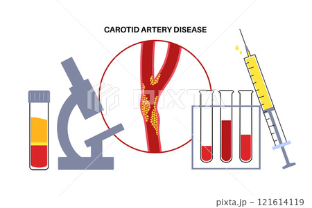 Carotid artery disease 121614119