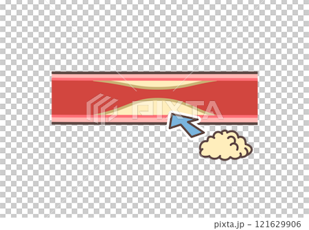 壞膽固醇和血管 121629906