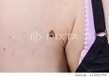 Dark fibroma, dermatology problem on skin. Close up of papilloma dermatosis 121642756
