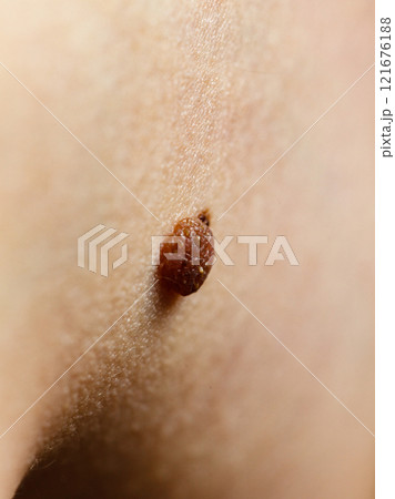 Closeup brown mole on skin. 121676188