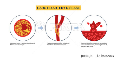 Carotid artery disease 121680903