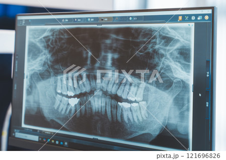 歯のレントゲン写真 歯のレントゲン写真 121696826