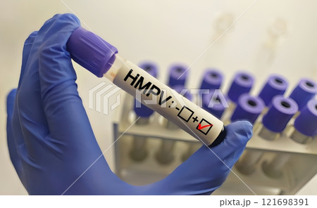Human Metapneumovirus (HMPV) positive test ,Medical health concept Human Metapneumovirus (HMPV) positive test ,Medical health concept 121698391