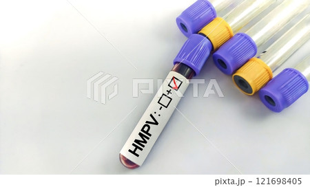 Human Metapneumovirus (HMPV) blood test Human Metapneumovirus (HMPV) blood test 121698405