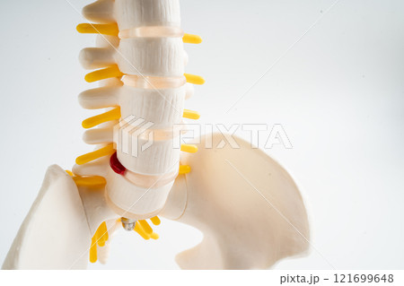Lumbar spine displaced herniated disc fragment, spinal nerve and bone. Model for treatment medical in the orthopedic department. 121699648