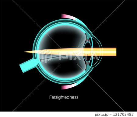 Farsightedness eye disease 121702483