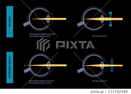 Farsightedness and nearsightedness correction Farsightedness and nearsightedness correction 121702486