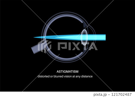Astigmatism eye disease 121702487
