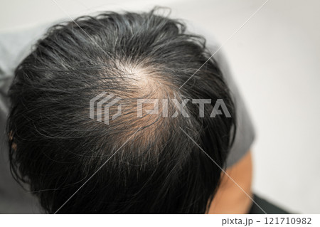 Bald head in man, hair loss treatment health problem. 121710982