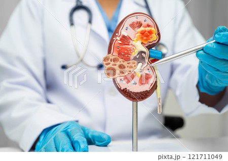 Chronic kidney disease, doctor with model for treatment urinary system, urology, Estimated glomerular filtration rate eGFR. 121711049