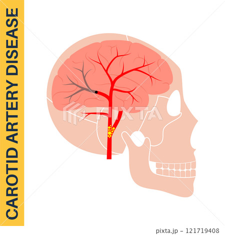 Carotid artery disease 121719408