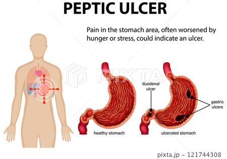 Understanding Peptic Ulcers and Stomach Pain Understanding Peptic Ulcers and Stomach Pain 121744308