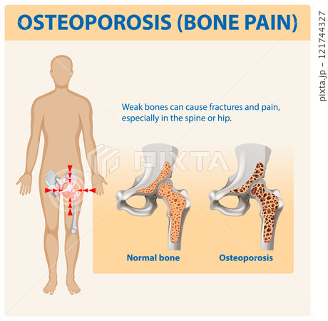 Understanding Osteoporosis and Bone Pain 121744327