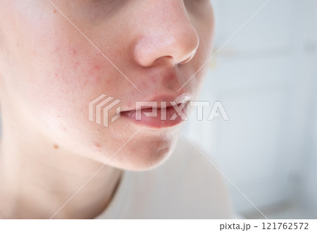 Close up of young woman with acne and post-acne marks on her cheeks. Hormonal acne, puberty and before menstruation, adult acne, rosacea. Close up of young woman with acne and post-acne marks on her cheeks. Hormonal acne, puberty and before menstruation, adult acne, rosacea. 121762572