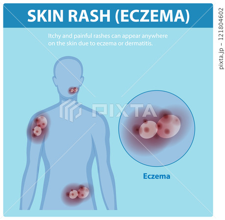 Understanding Eczema and Skin Rashesのイラスト素材 [121804602] - PIXTA