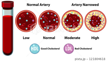 Understanding Artery Health and Cholesterol Levels 121804618
