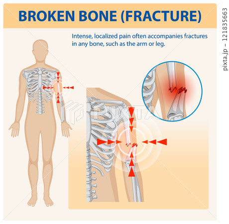 Understanding Bone Fractures and Pain Understanding Bone Fractures and Pain 121835663