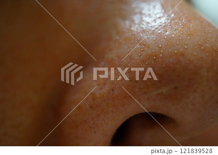 白い角栓が詰まった鼻の毛穴　アップ 121839528