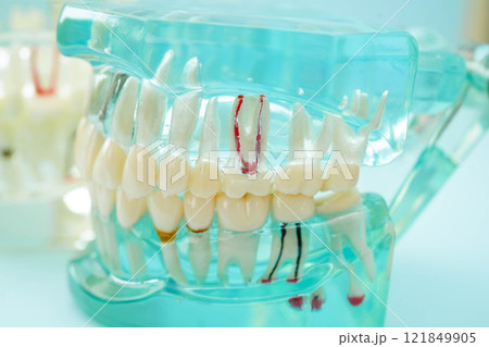 Dental implant, artificial tooth roots into jaw, root canal of dental treatment, gum disease, teeth model for dentist studying about dentistry. Dental implant, artificial tooth roots into jaw, root canal of dental treatment, gum disease, teeth model for dentist studying about dentistry. 121849905