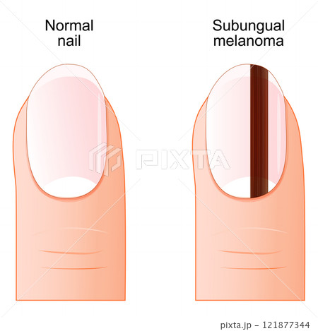 Subungual melanoma. Nail cancer. Subungual melanoma. Nail cancer. 121877344