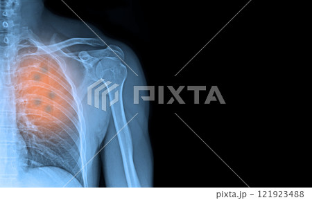 X-ray images chest and shoulder 121923488