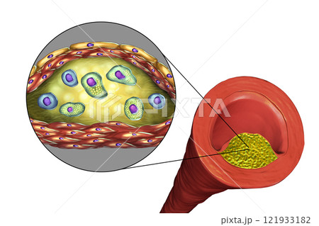 Atherosclerotic plaque in human artery 121933182
