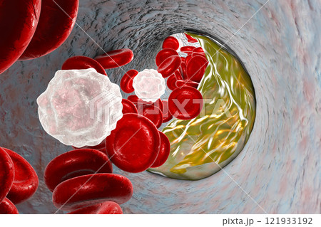 Atheroma plaque inside artery Atheroma plaque inside artery 121933192