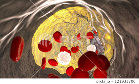 Atherosclerosis, atheromatous plaque inside artery 121933200