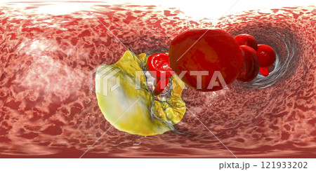 Atherosclerosis, atheromatous plaque inside artery 121933202